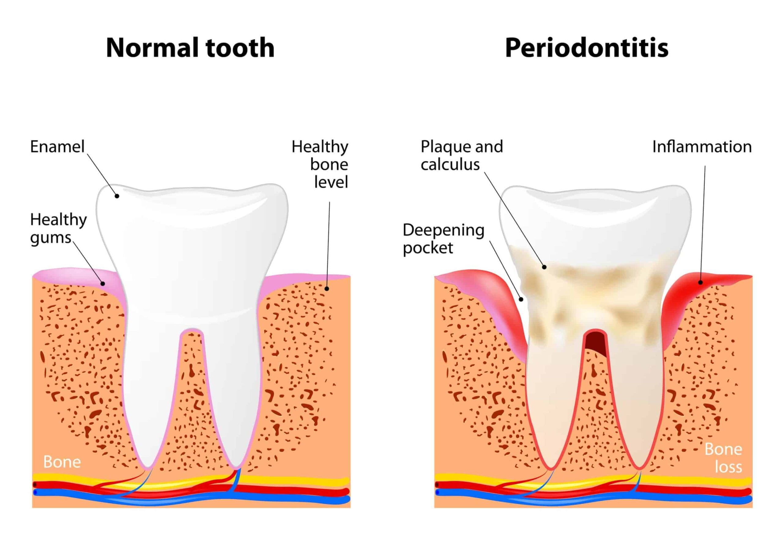 bigstock Periodontitis 95581808 scaled 1 scaled