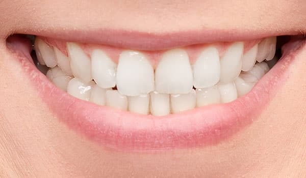 Big White Smile After Teeth Whitening - Gosford, NSW