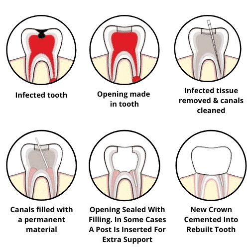 process of root canal in diagram