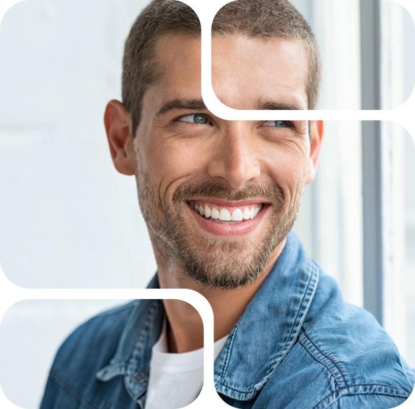 veneers 3