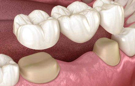 3D Illustration Of Dental Bridge — Dentist In Gosford, NSW