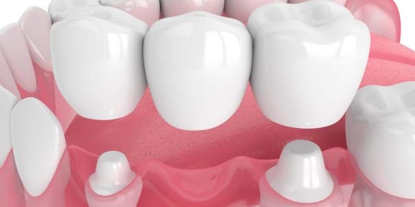 3D Render Of Dental Bridge — Dentist In Gosford, NSW