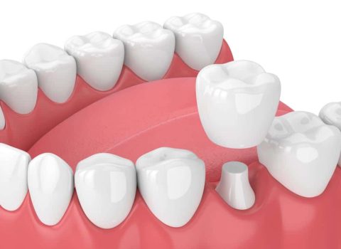 3D Render Of Dental Crown Restoration — Dentist In Gosford, NSW