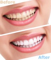 Before and After Teeth Cleaning — Albany Dental in Gosford, NSW