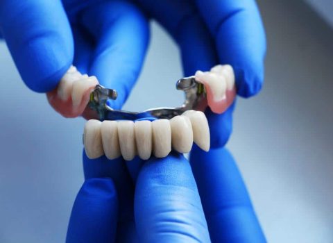 Close Up Image Of Dental Bridge — Dentist In Gosford, NSW