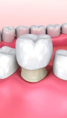 Dental Crown Installation Process — Dentist In Gosford, NSW