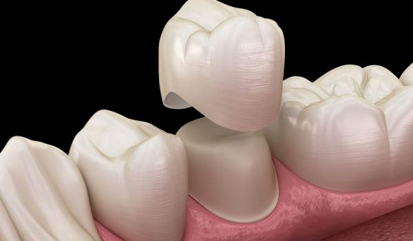 Dental Crown Premolar Tooth Assembly Process — Dentist In Gosford, NSW