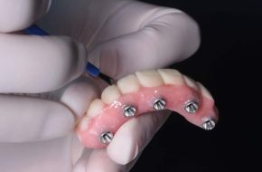 Dental Technician Working On Full Arch Acrylic Bridge — Dentist In Gosford, NSW