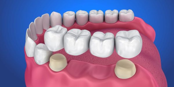 Tooth Supported Fixed Bridge — Dentist In Gosford, NSW
