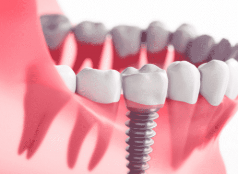 cartoon of dental implant