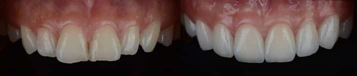 close up of teeth before and after teeth whitening and veneers