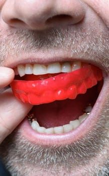 Sport Mouthguard Inserting By Patient — Dentist In Gosford, NSW