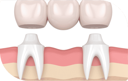 Root Canal Extraction — Dentist In Gosford, NSW
