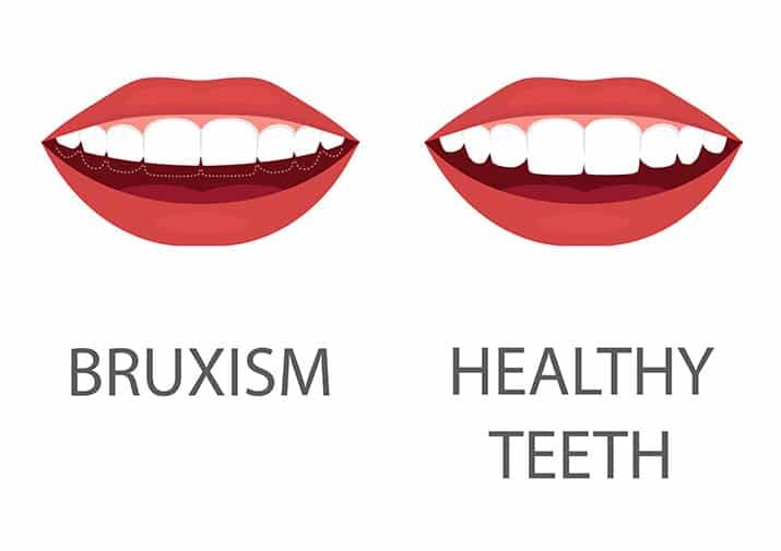 dental diagram displaying bruxism vs healthy teeth